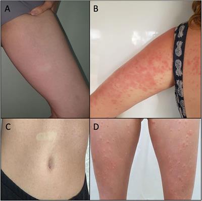 Case Report: Cannabidiol-Induced Skin Rash: A Case Series and Key Recommendations